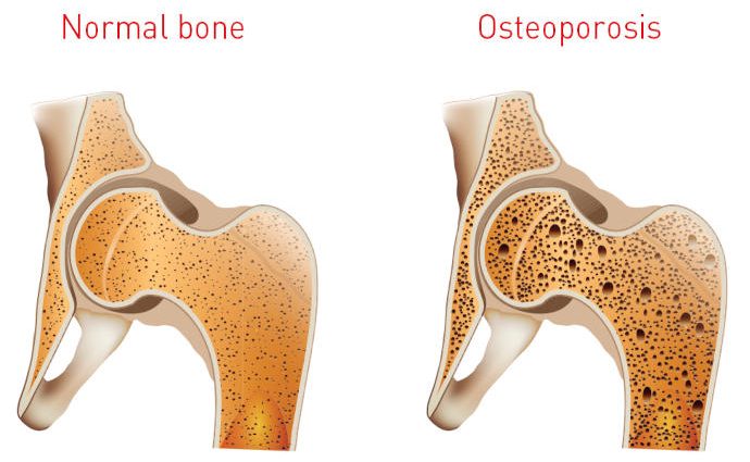 Coffee Osteoporosis